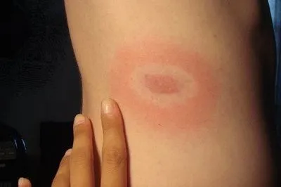 Что делать, если ребёнка укусил клещ: отвечает врач