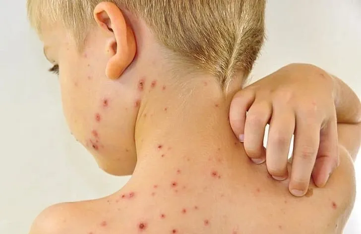 «Ребенок лег спать здоровым, а ночью…»: Врач-педиатр о коварстве менингококка и главном симптоме, который нельзя пропустить