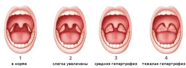 Самые распространенные детские ЛОР-операции
