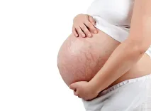 Как бороться с растяжками во время беременности